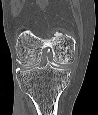Figure 3 for case Medial meniscus tear ( RID2772 )